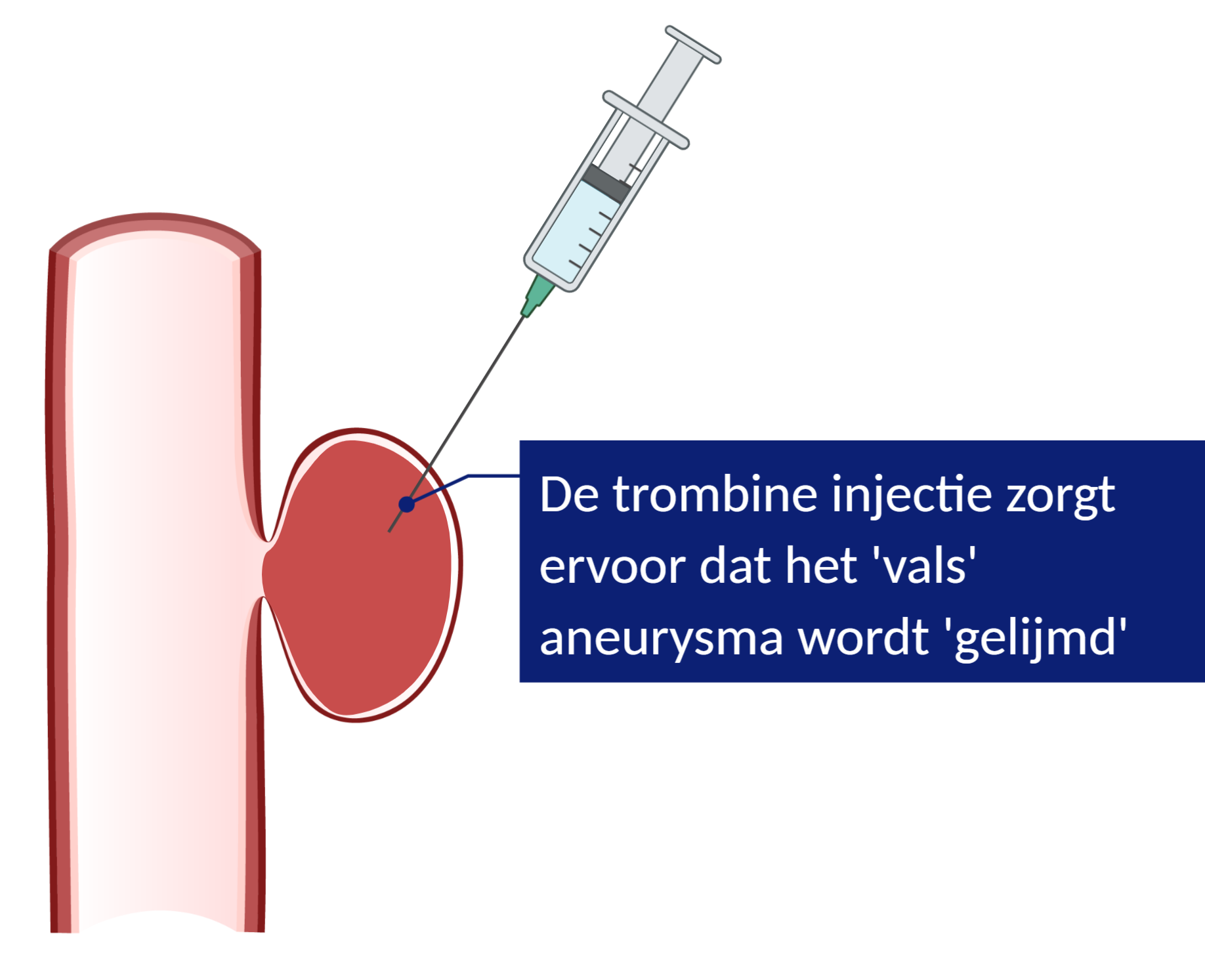 Met een trombine injectie spuiten we trombine in het 'vals' aneurysma, zodat het aneurysma wordt dichtgelijmd.